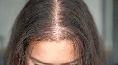 What is hair fall